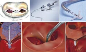 M-TEER (Reparo Transcateter da Valva Mitral)
