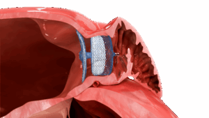 Oclusão de Apêndice Atrial Esquerdo