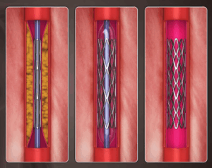 Angioplastia coronária
