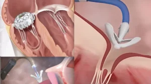 Tratamento Transcateter da Valva Tricúspide